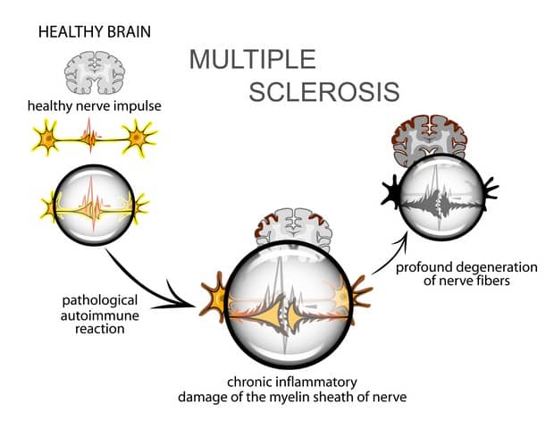 What Is Multiple Sclerosis?