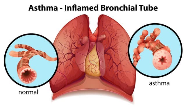 10 Interesting Stats On Asthma!