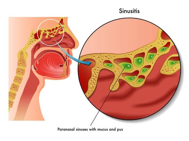 Concluding Thoughts On Mold and Sinusitis!